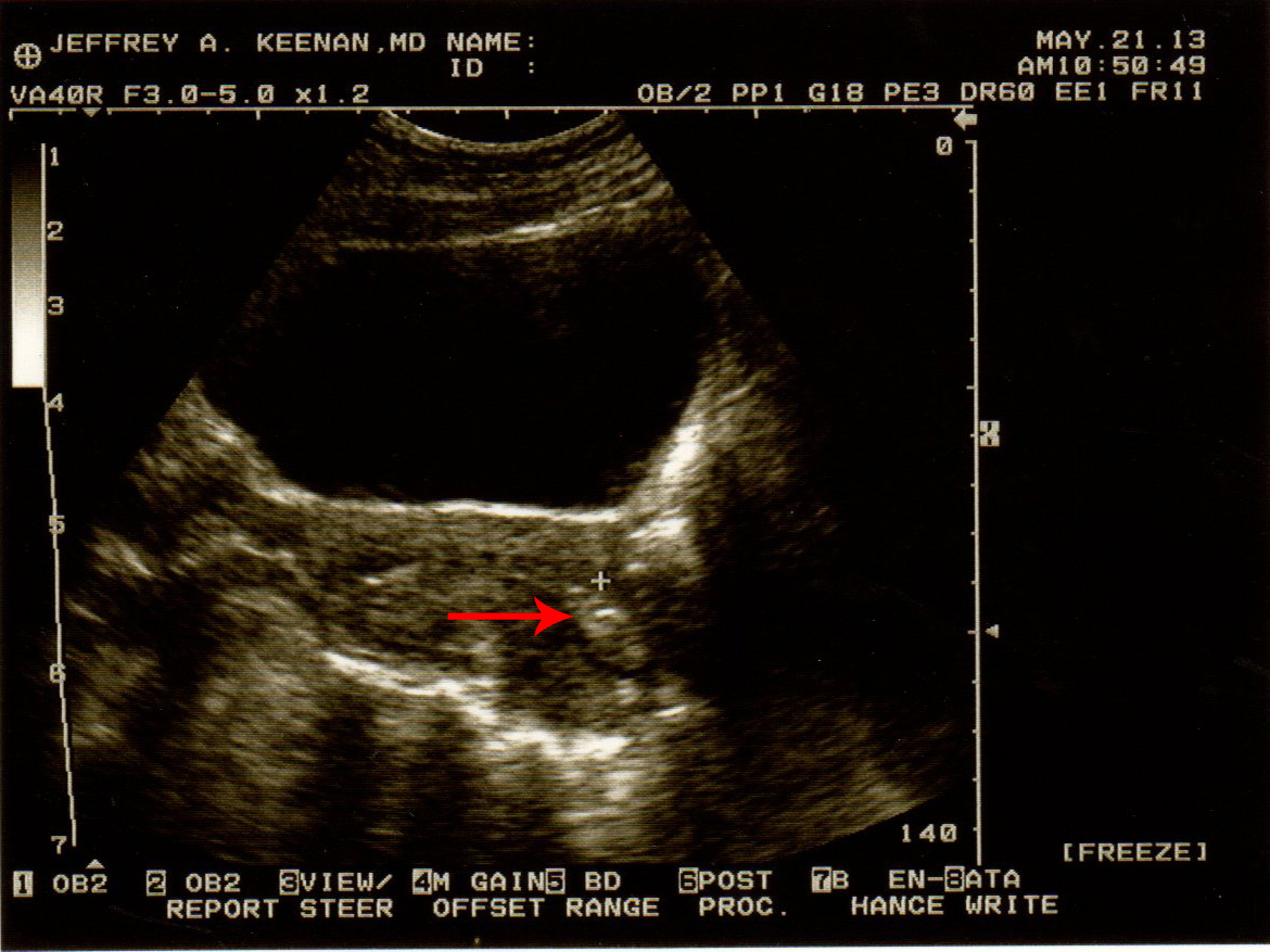 Both embryos implanted in Adrienne's uterus